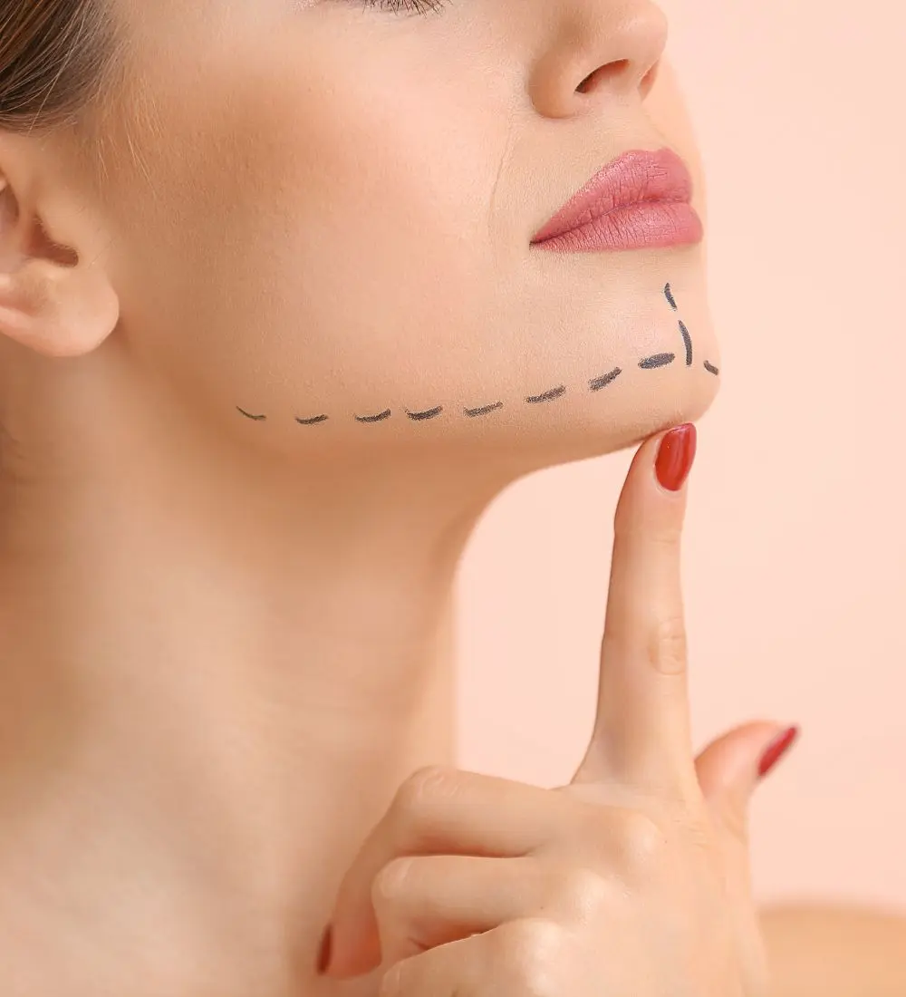 Mentoplastia – foto Mentoplastia - foto