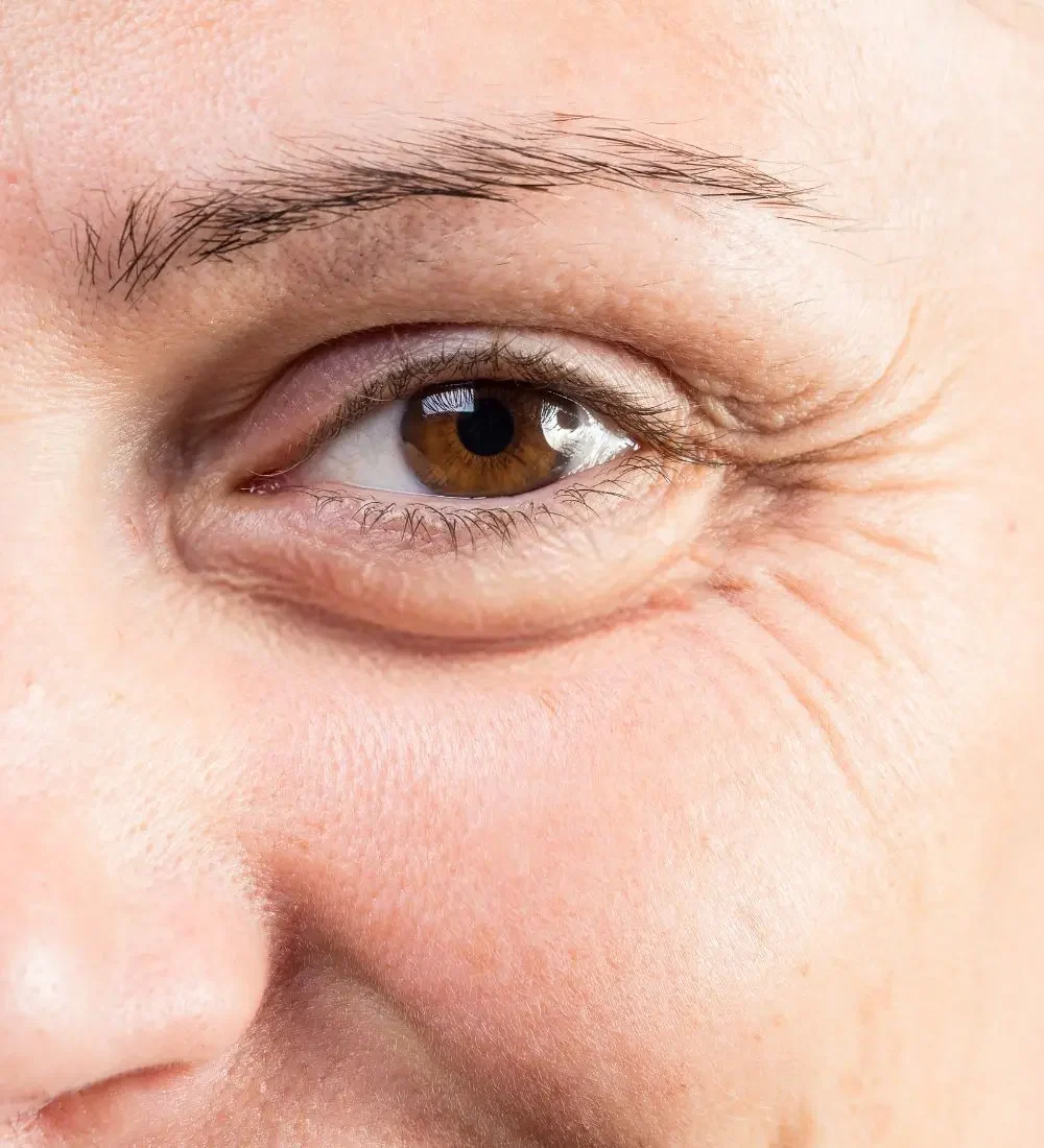 Blefaroplastia - foto