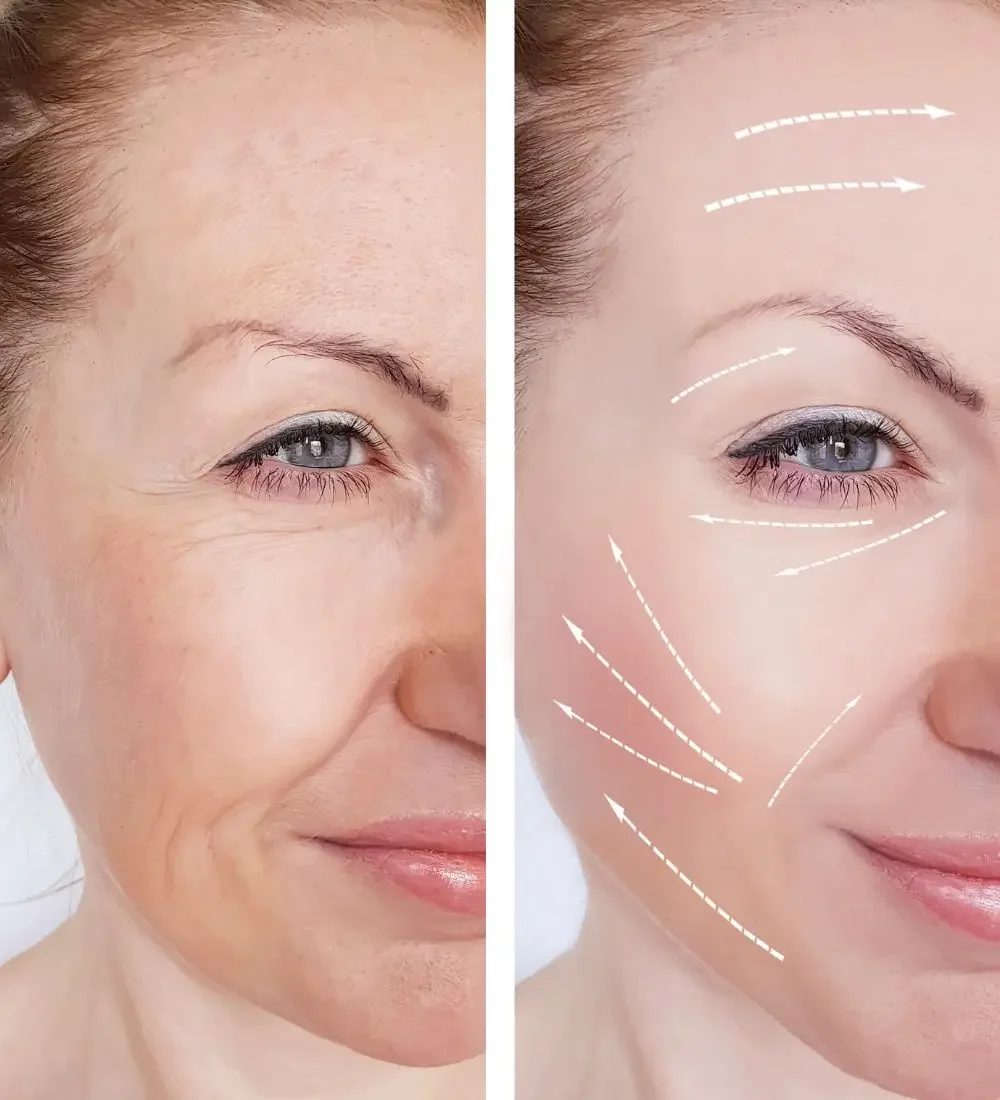 Ritidectomía (lifting facial) - foto